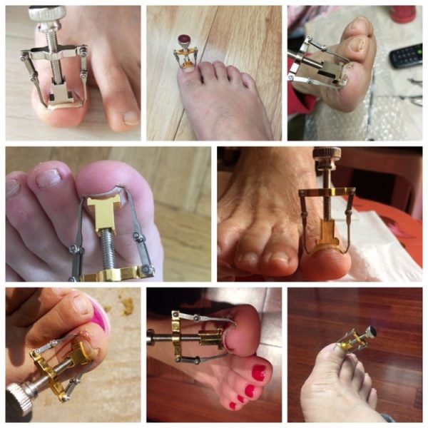 Ingrown Toenails Pedicure Foot Nail Care Tools – Image 5