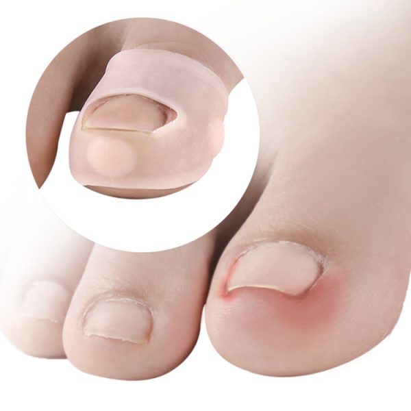 Ingrown Nails Prevent Nails From Growing Flesh Nail Corrections – Image 4