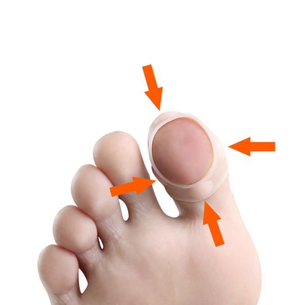 Ingrown Nails Prevent Nails From Growing Flesh Nail Corrections – Image 5